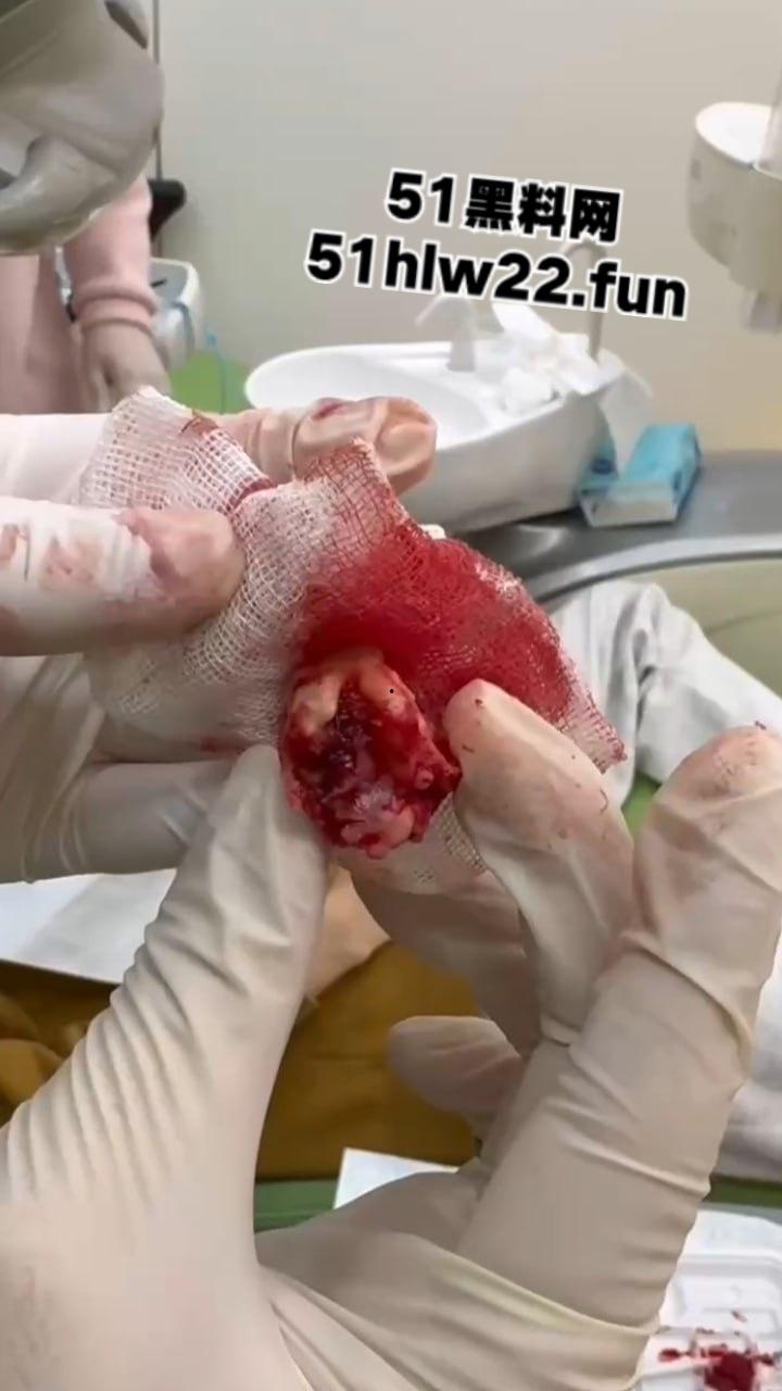 口腔医院逆天操作,客人拔智齿结果医生不分青红皂白直接大力出奇迹, 把上颌骨拔断撤了下来! 第1张 口腔医院逆天操作,客人拔智齿结果医生不分青红皂白直接大力出奇迹, 把上颌骨拔断撤了下来! 第1张