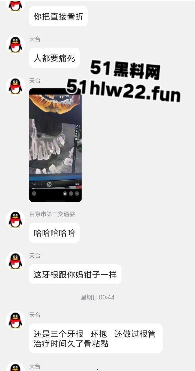 口腔医院逆天操作,客人拔智齿结果医生不分青红皂白直接大力出奇迹, 把上颌骨拔断撤了下来! 第3张 口腔医院逆天操作,客人拔智齿结果医生不分青红皂白直接大力出奇迹, 把上颌骨拔断撤了下来! 第3张