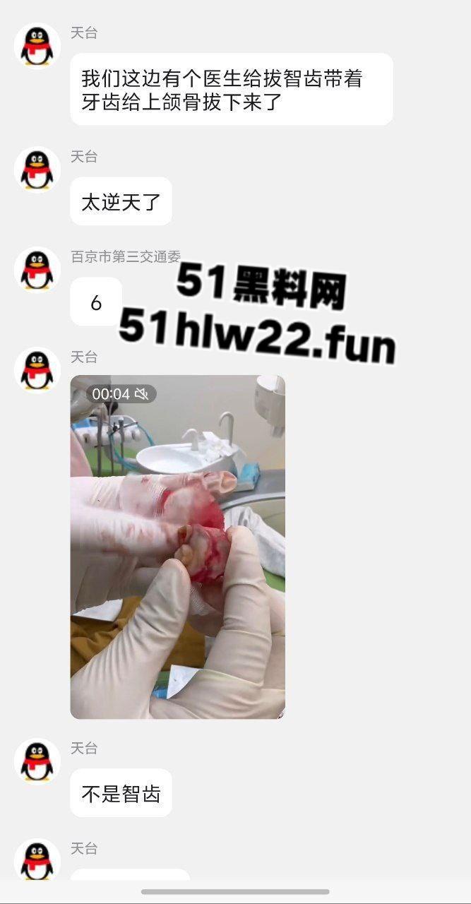 口腔医院逆天操作,客人拔智齿结果医生不分青红皂白直接大力出奇迹, 把上颌骨拔断撤了下来! 第4张 口腔医院逆天操作,客人拔智齿结果医生不分青红皂白直接大力出奇迹, 把上颌骨拔断撤了下来! 第4张