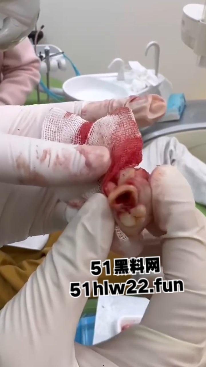口腔医院逆天操作,客人拔智齿结果医生不分青红皂白直接大力出奇迹, 把上颌骨拔断撤了下来! 第5张 口腔医院逆天操作,客人拔智齿结果医生不分青红皂白直接大力出奇迹, 把上颌骨拔断撤了下来! 第5张