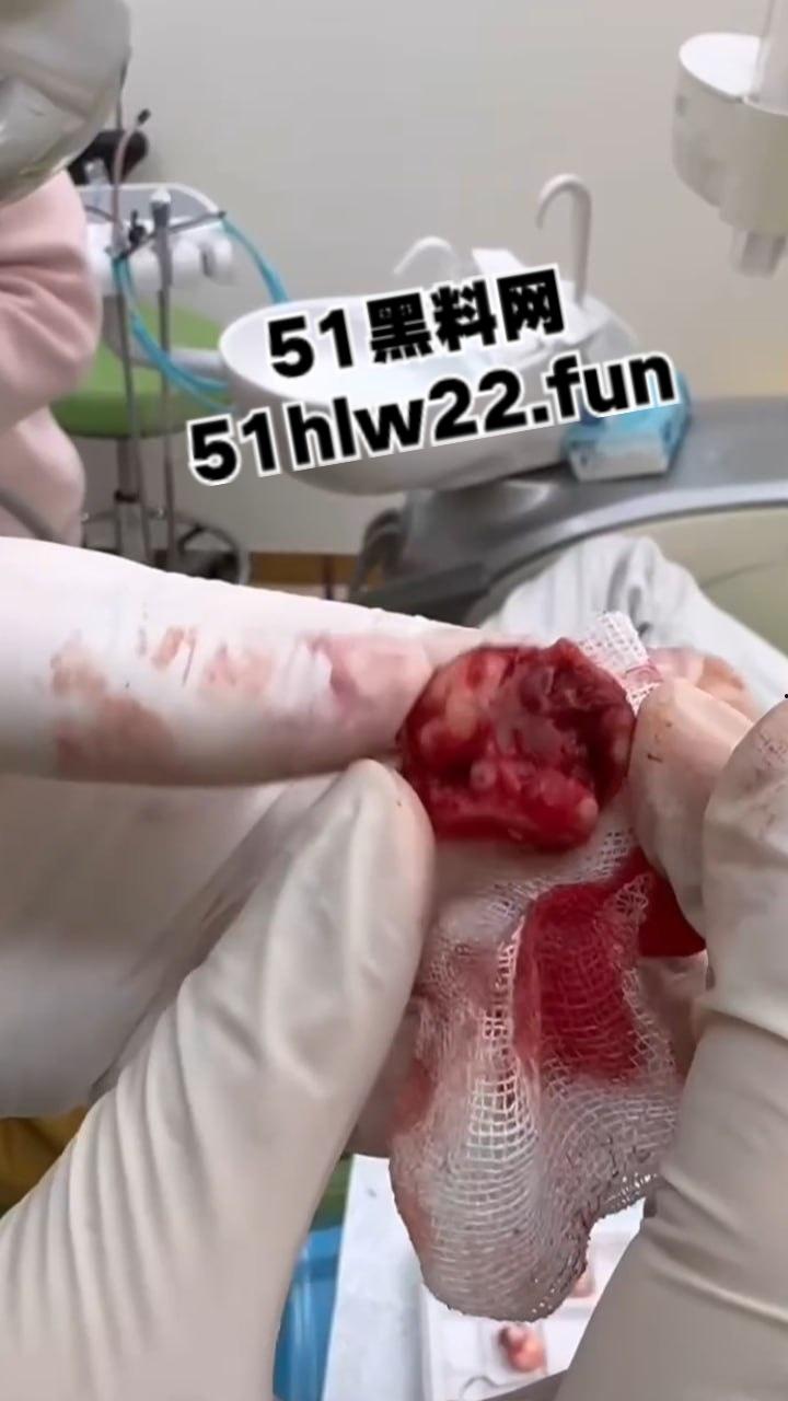 口腔医院逆天操作,客人拔智齿结果医生不分青红皂白直接大力出奇迹, 把上颌骨拔断撤了下来! 第6张 口腔医院逆天操作,客人拔智齿结果医生不分青红皂白直接大力出奇迹, 把上颌骨拔断撤了下来! 第6张