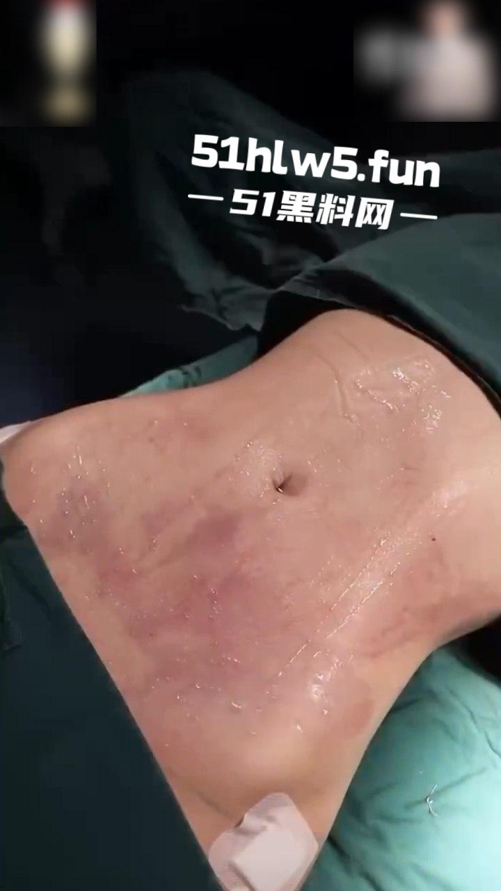 实拍整形医院，小仙女整容抽脂和填充全过程，看着残忍但做完后惊艳的效果让人震撼。  第5张