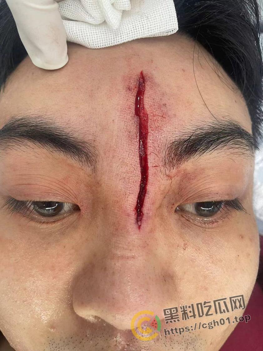 一场野球挣了66w！广州汇悦台野球场暴躁男【王帅】打球带肘给人开瓢  赔66w才能免坐牢 第3张