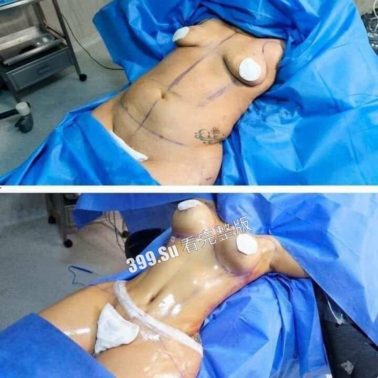 医美整形那些事儿 假的真不了  女人对自己真狠 阴唇黑了就直接切掉 （二） 第1张