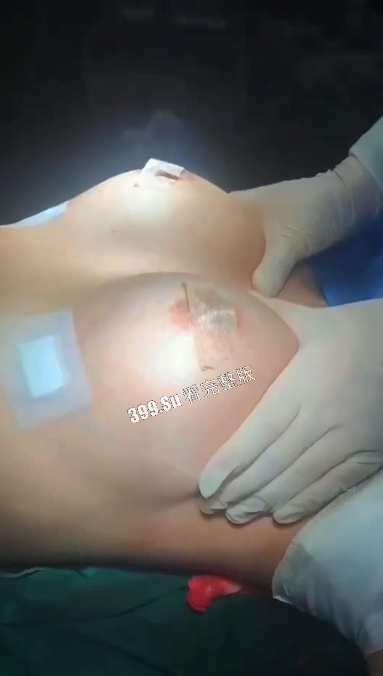 医美整形那些事儿 假的真不了  女人对自己真狠 阴唇黑了就直接切掉 （二） 第6张