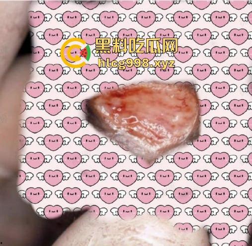 梅毒像疯狗一样乱咬！日本疫情横扫全球，日本卫生部出狠招断根大法安排上，管不住下半身只能禁爱？  第4张