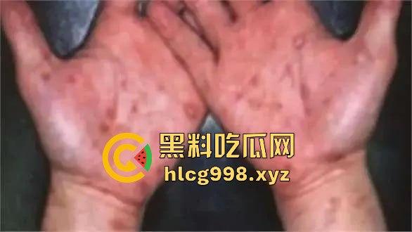 梅毒像疯狗一样乱咬！日本疫情横扫全球，日本卫生部出狠招断根大法安排上，管不住下半身只能禁爱？  第12张