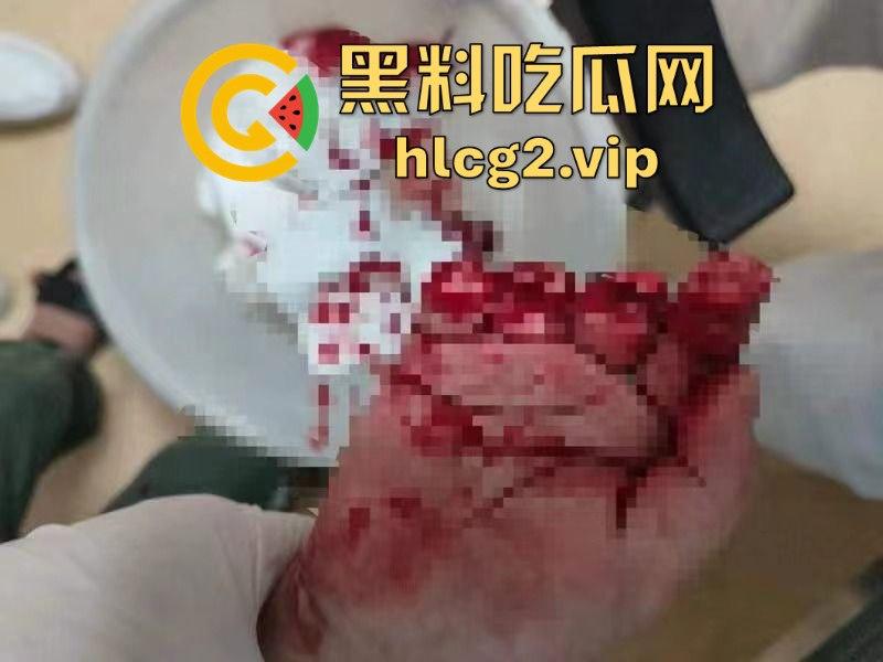 南宁熊孩子玩奶茶封口机被夹断四根手指！家长慌了才后悔疏忽奶茶店一片惊叫！  第9张