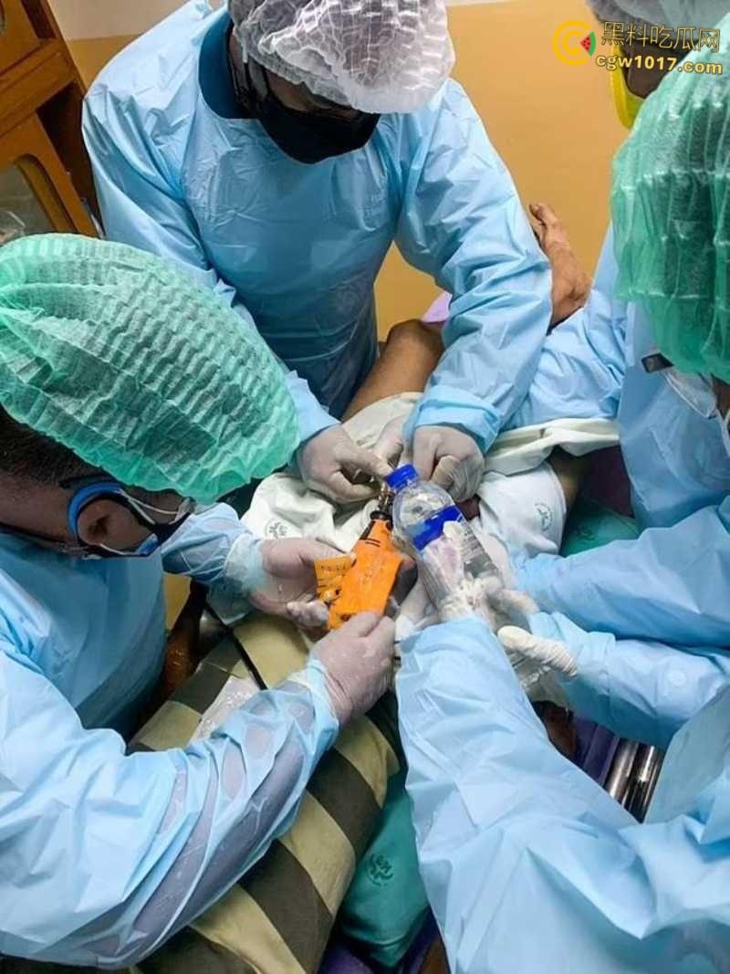 小说照进现实,男子追求刺激螺母自慰,勃起后被螺母卡住,消防人员和医生同时出动,解救被困阴茎 ! 第3张 小说照进现实,男子追求刺激螺母自慰,勃起后被螺母卡住,消防人员和医生同时出动,解救被困阴茎 ! 第3张