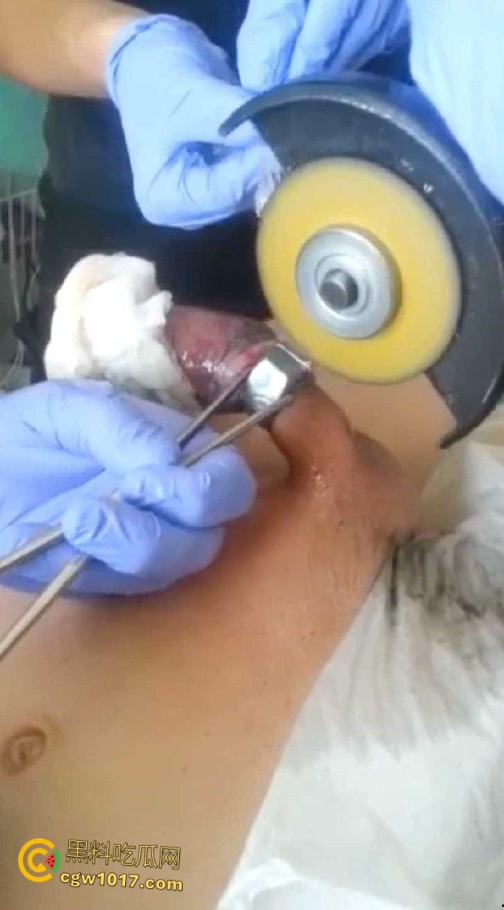 小说照进现实,男子追求刺激螺母自慰,勃起后被螺母卡住,消防人员和医生同时出动,解救被困阴茎 ! 第4张 小说照进现实,男子追求刺激螺母自慰,勃起后被螺母卡住,消防人员和医生同时出动,解救被困阴茎 ! 第4张