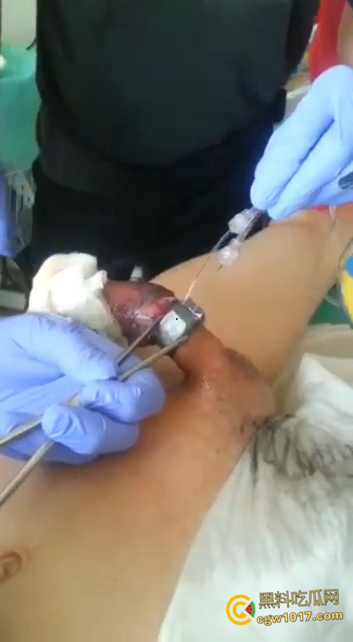 小说照进现实,男子追求刺激螺母自慰,勃起后被螺母卡住,消防人员和医生同时出动,解救被困阴茎 ! 第5张 小说照进现实,男子追求刺激螺母自慰,勃起后被螺母卡住,消防人员和医生同时出动,解救被困阴茎 ! 第5张