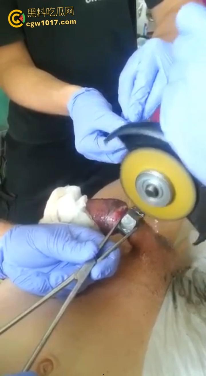 小说照进现实,男子追求刺激螺母自慰,勃起后被螺母卡住,消防人员和医生同时出动,解救被困阴茎 ! 第6张 小说照进现实,男子追求刺激螺母自慰,勃起后被螺母卡住,消防人员和医生同时出动,解救被困阴茎 ! 第6张