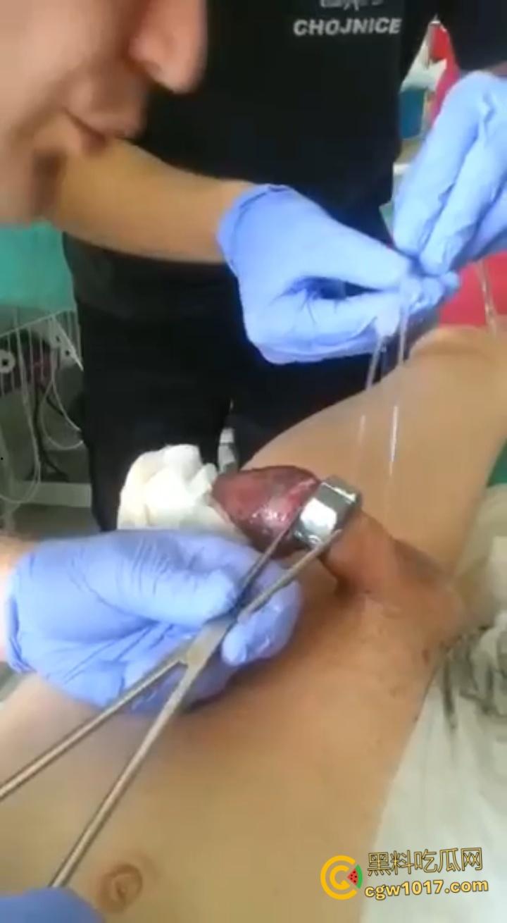 小说照进现实,男子追求刺激螺母自慰,勃起后被螺母卡住,消防人员和医生同时出动,解救被困阴茎 ! 第7张 小说照进现实,男子追求刺激螺母自慰,勃起后被螺母卡住,消防人员和医生同时出动,解救被困阴茎 ! 第7张