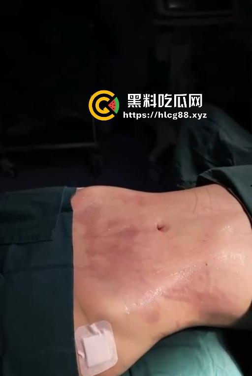 现在妹子为美疯魔抽脂隆奶塞逼艾灸,骚穴子宫烤得喷香,医美变态到艾灸鸡巴都出现了! 第12张 现在妹子为美疯魔抽脂隆奶塞逼艾灸,骚穴子宫烤得喷香,医美变态到艾灸鸡巴都出现了! 第12张