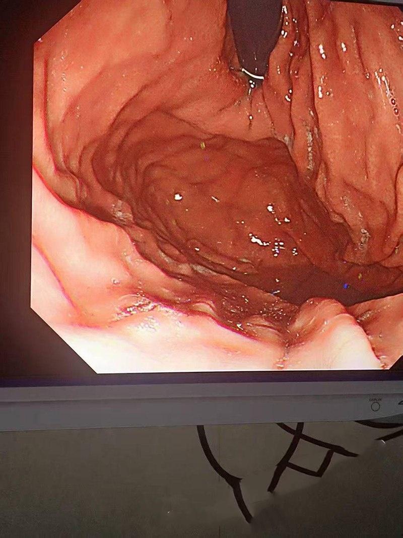 真刺激!男模激情拳交玩过火,结果金戒指卡屁眼里,深夜紧急送医取出,医生直叹牛逼 第6张 真刺激!男模激情拳交玩过火,结果金戒指卡屁眼里,深夜紧急送医取出,医生直叹牛逼 第6张