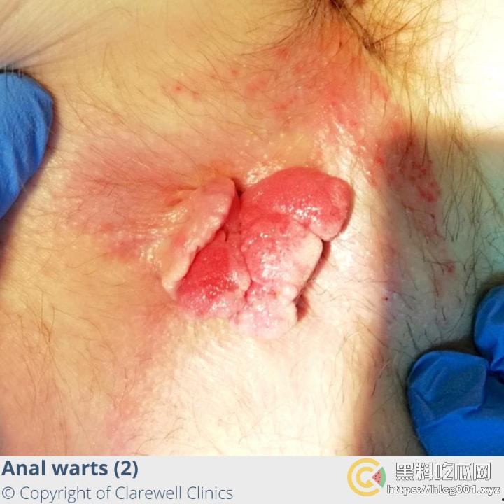 性病篇  谨慎观看！瓜友们出门在外 一定得洁身自爱 世界上没有后悔药 安全第一！！！ （二） 第3张