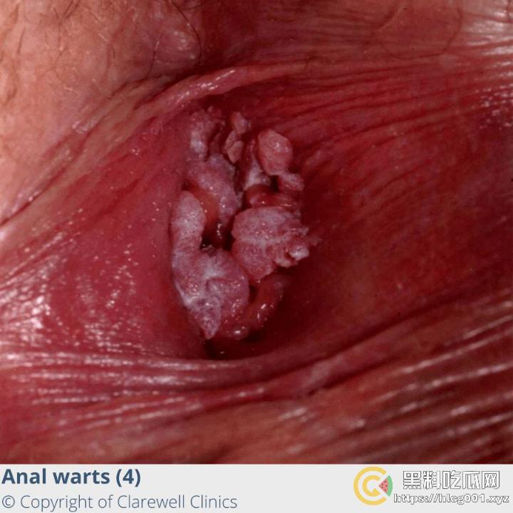 性病篇  谨慎观看！瓜友们出门在外 一定得洁身自爱 世界上没有后悔药 安全第一！！！ （二） 第5张