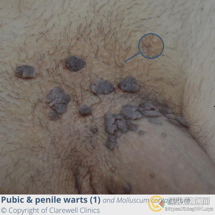 性病篇  谨慎观看！瓜友们出门在外 一定得洁身自爱 世界上没有后悔药 安全第一！！！ （二） 第7张