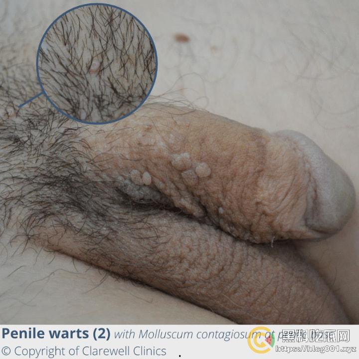 性病篇  谨慎观看！瓜友们出门在外 一定得洁身自爱 世界上没有后悔药 安全第一！！！ （二） 第10张