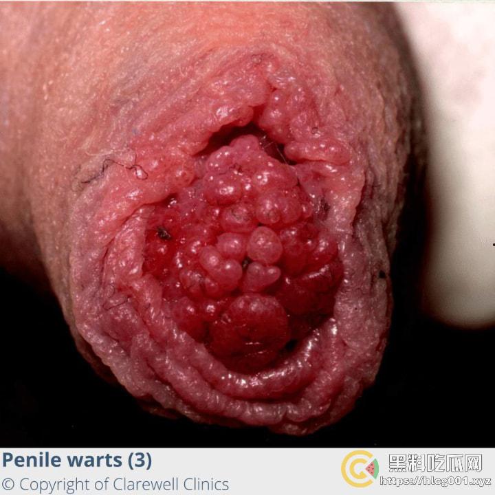 性病篇  谨慎观看！瓜友们出门在外 一定得洁身自爱 世界上没有后悔药 安全第一！！！ （二） 第11张