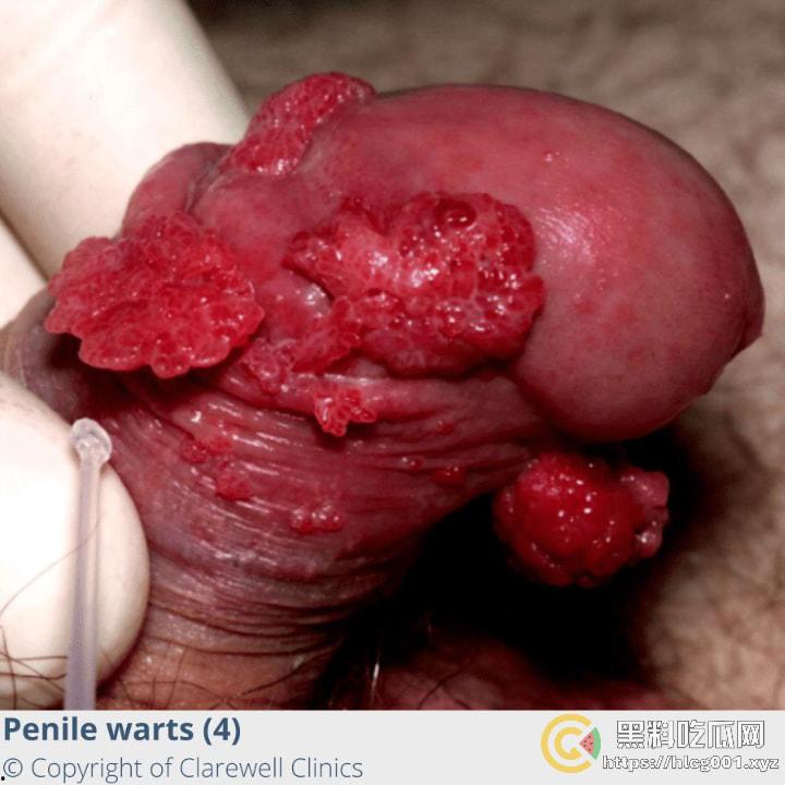 性病篇  谨慎观看！瓜友们出门在外 一定得洁身自爱 世界上没有后悔药 安全第一！！！ （二） 第12张