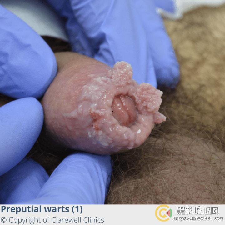 性病篇  谨慎观看！瓜友们出门在外 一定得洁身自爱 世界上没有后悔药 安全第一！！！ （二） 第13张