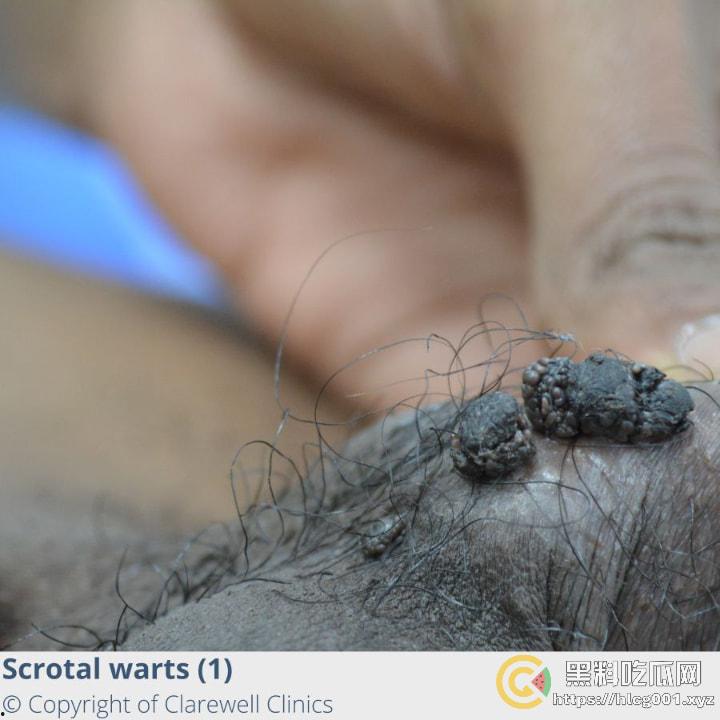 性病篇  谨慎观看！瓜友们出门在外 一定得洁身自爱 世界上没有后悔药 安全第一！！！ （二） 第16张