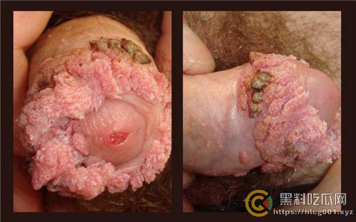 性病篇  谨慎观看！瓜友们出门在外 一定得洁身自爱 世界上没有后悔药 安全第一！！！ （二） 第17张