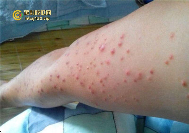 可怕！为了报复社会把带血针头扎进了共享单车的座椅里……山东商业技师学校20个被感染艾滋！！！  第7张