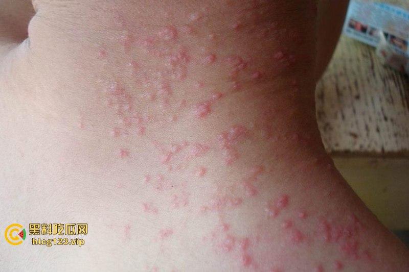 可怕！为了报复社会把带血针头扎进了共享单车的座椅里……山东商业技师学校20个被感染艾滋！！！  第8张