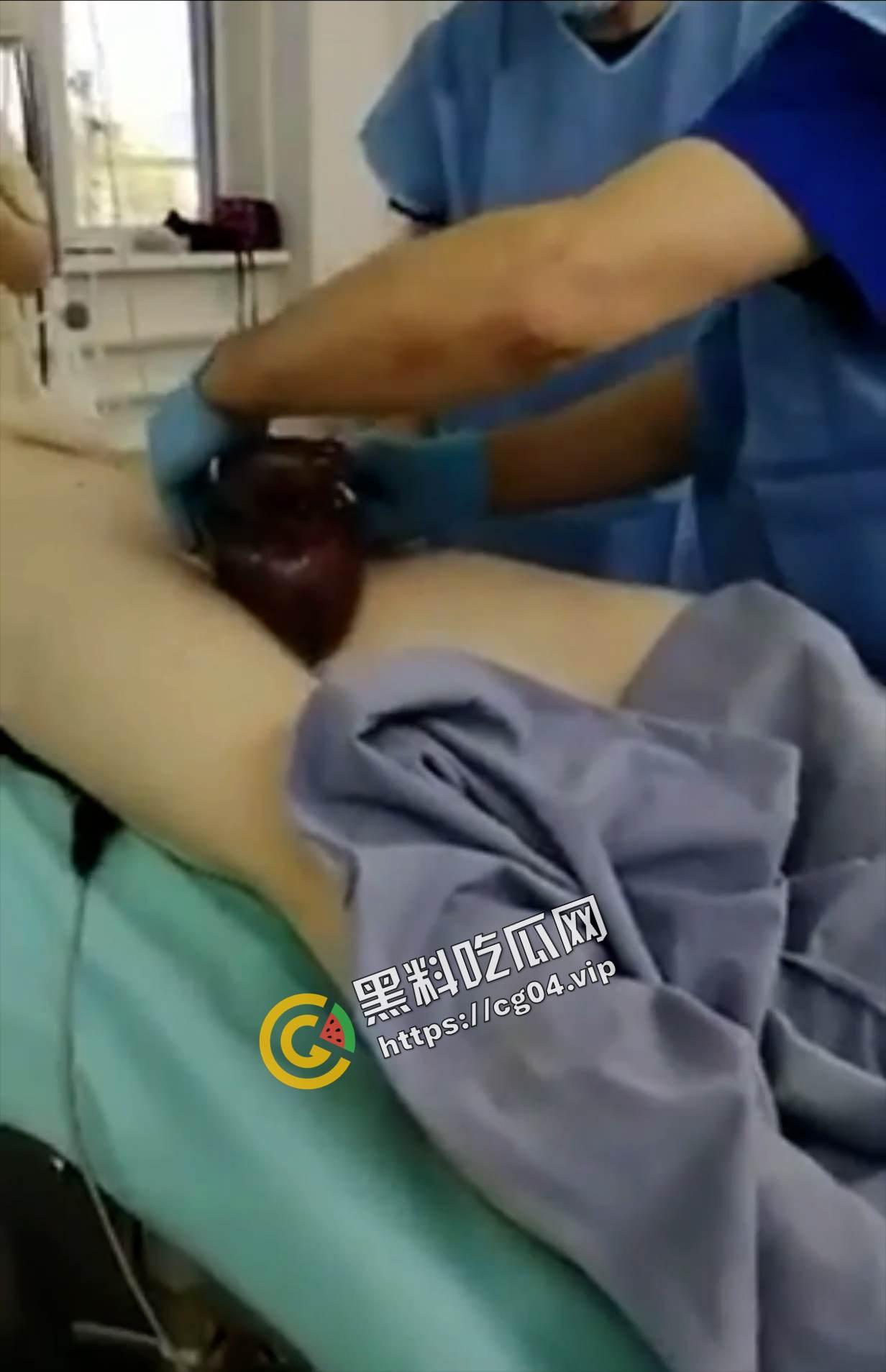 玩的花不是叫你玩命!w外国男子阳具被锁肿成大蒜一样 医生都束手无策  第4张