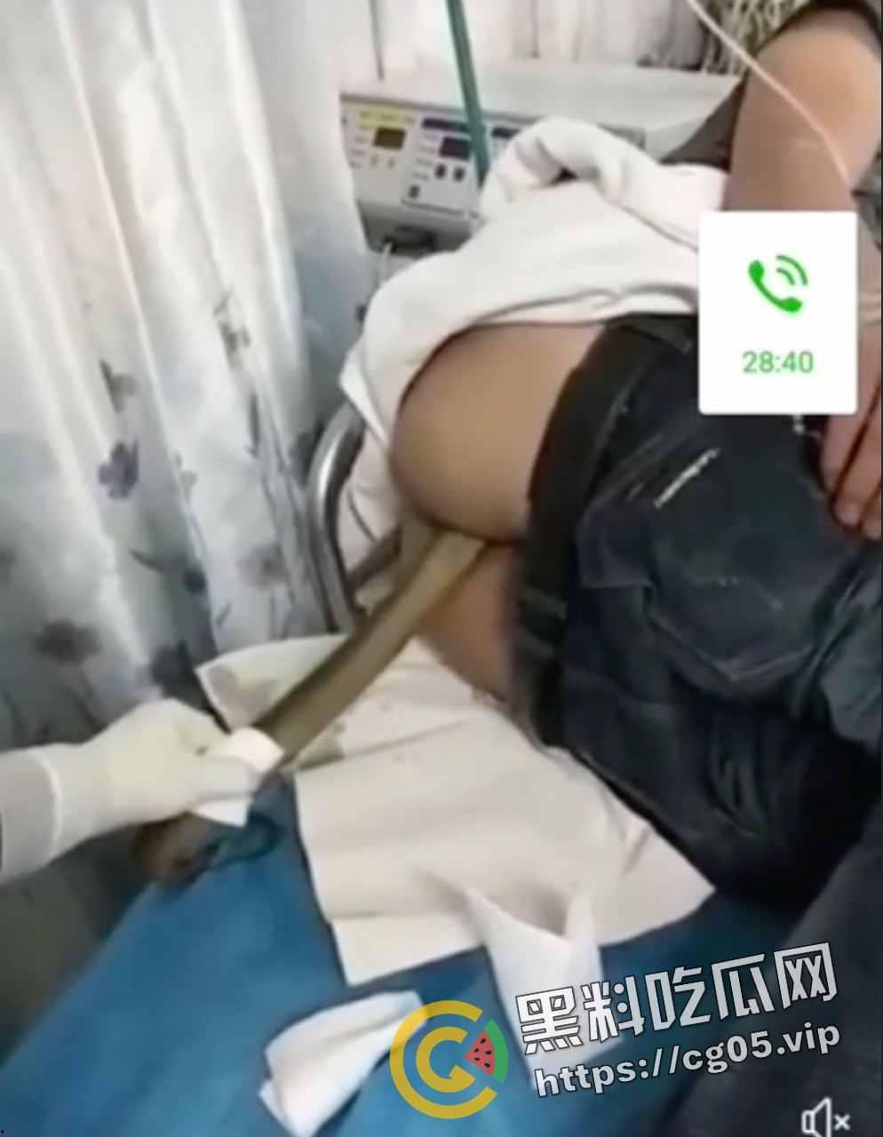 黄鳝入肛 一去不回 整活把自己整进医院了 医生扯出来半米长的黄鳝惊呆了  第2张