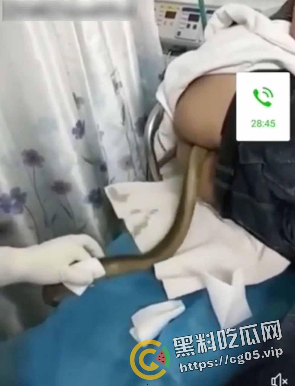 黄鳝入肛 一去不回 整活把自己整进医院了 医生扯出来半米长的黄鳝惊呆了  第3张