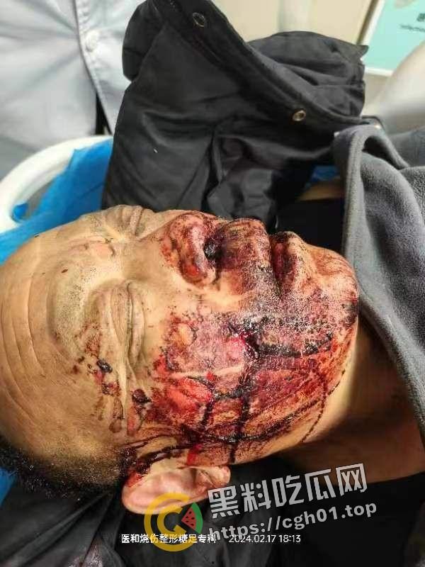 北京马坊镇放火杀人案 犯人【刘峰强】被抓 受害人全身烧烂 手臂被砍 全家老小失去人形 惨不忍睹 血腥慎点  第16张