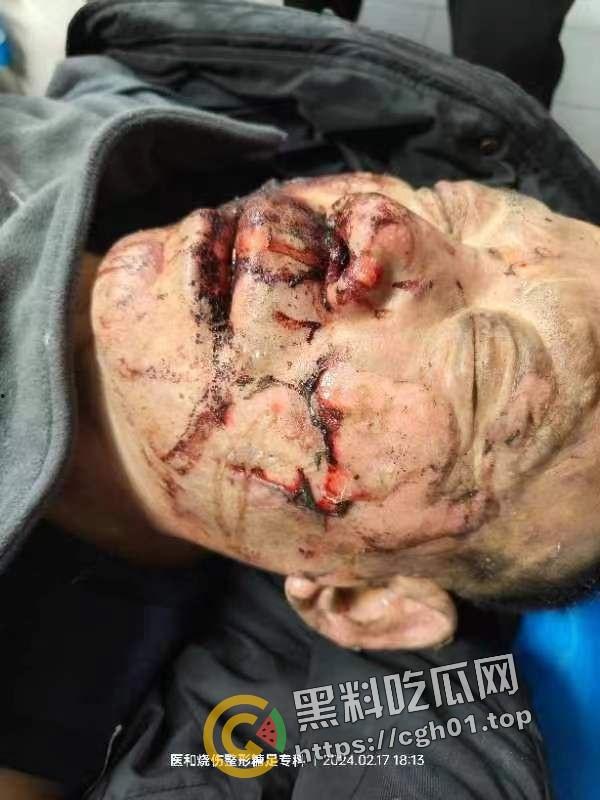 北京马坊镇放火杀人案 犯人【刘峰强】被抓 受害人全身烧烂 手臂被砍 全家老小失去人形 惨不忍睹 血腥慎点  第17张