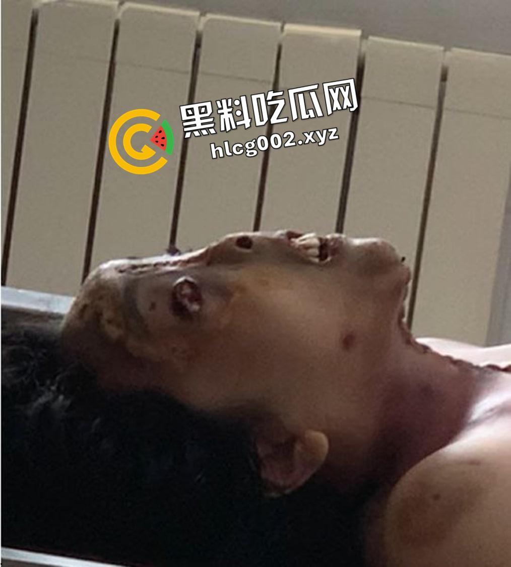 恐怖慎入！辽宁【徐园】案尸检现场视频流出 被前男友家暴致死打的面目全非  第5张