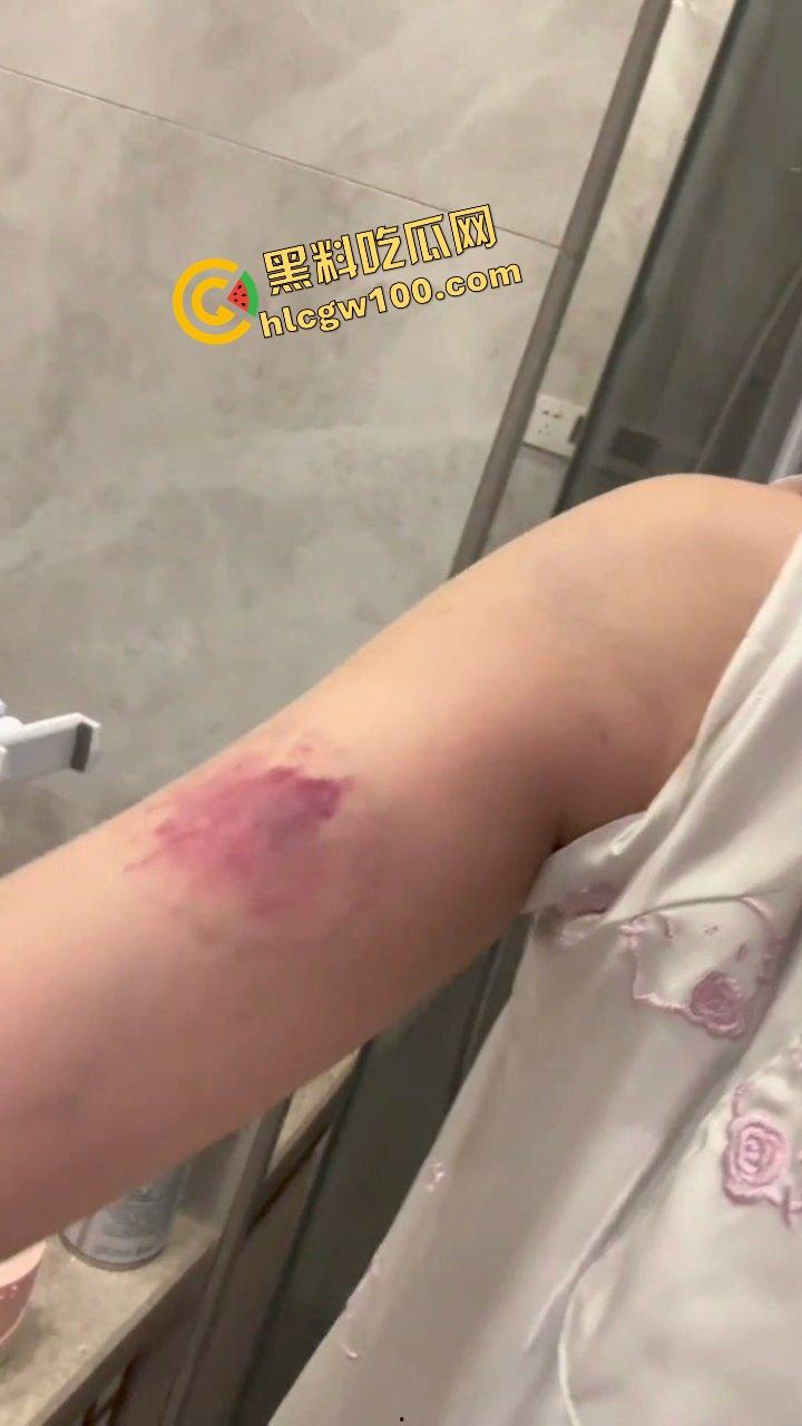 街球圈情侣大瓜！杭州街球手【程鑫凯】家暴女网红【鸡腿诺】多处打伤哭泣现场！独家开盒流出！  第16张