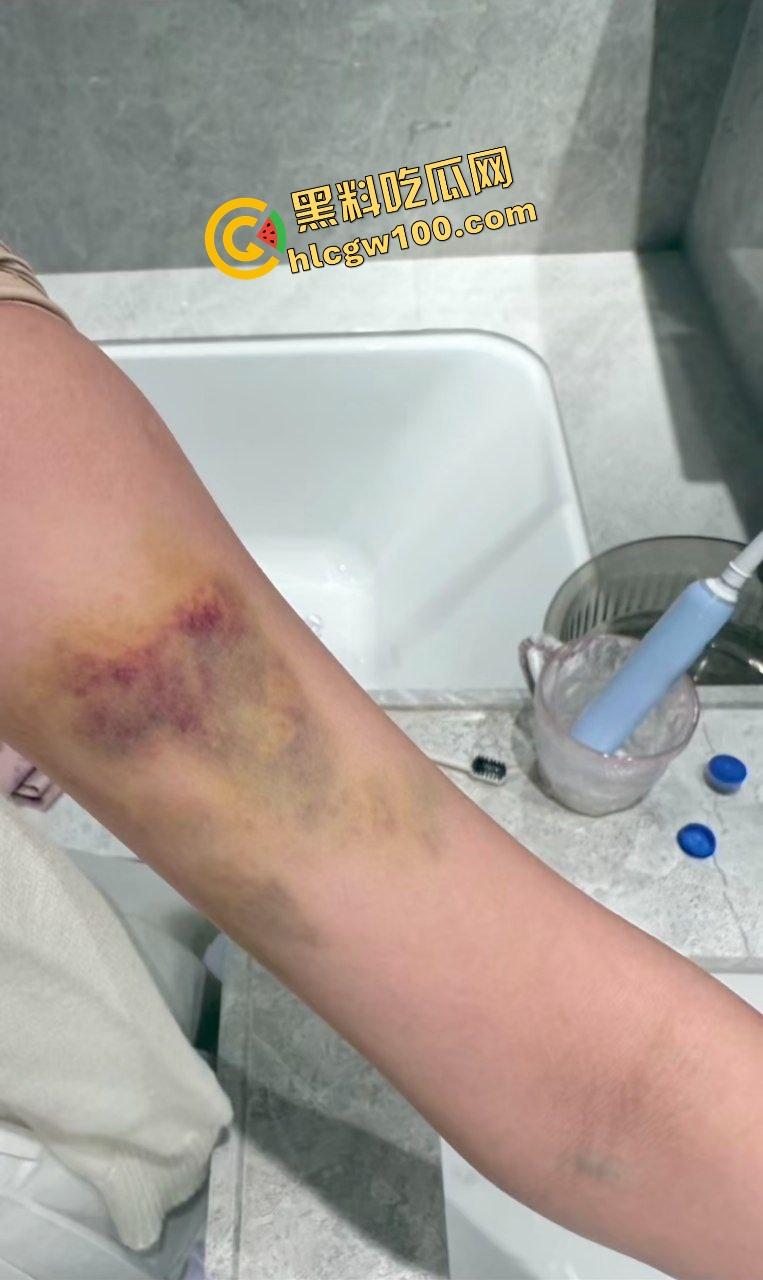 街球圈情侣大瓜！杭州街球手【程鑫凯】家暴女网红【鸡腿诺】多处打伤哭泣现场！独家开盒流出！  第17张