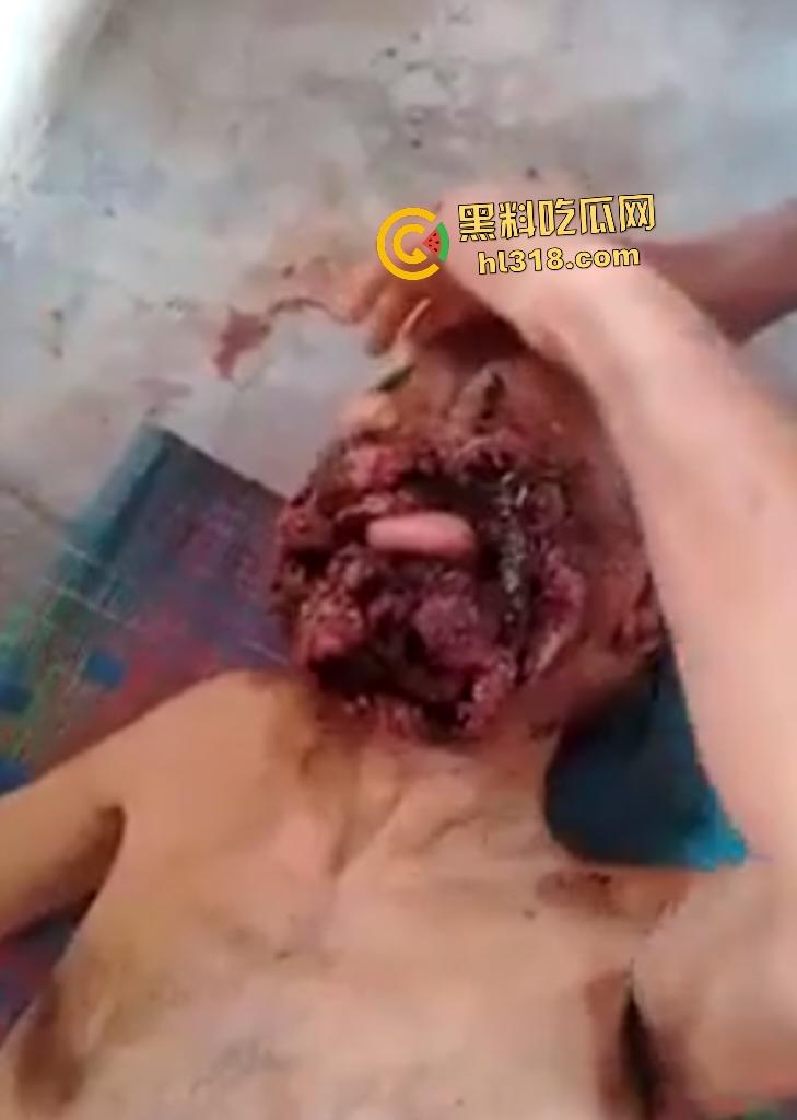 埃及老人惨遭机器重击,脸烂成浆五官全毁,只能阿巴阿巴发声音,不能说话,估计过几天就要长蛆了! 第1张 埃及老人惨遭机器重击,脸烂成浆五官全毁,只能阿巴阿巴发声音,不能说话,估计过几天就要长蛆了! 第1张