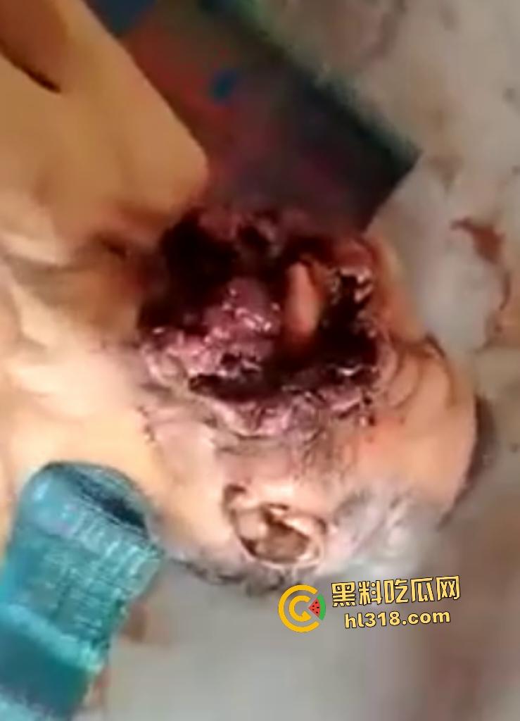 埃及老人惨遭机器重击,脸烂成浆五官全毁,只能阿巴阿巴发声音,不能说话,估计过几天就要长蛆了! 第8张 埃及老人惨遭机器重击,脸烂成浆五官全毁,只能阿巴阿巴发声音,不能说话,估计过几天就要长蛆了! 第8张