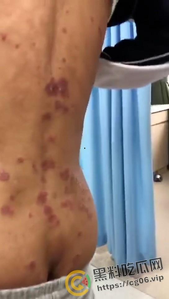 初三学生化身毒王 梅毒三期 艾滋 浑身腐烂 牛子流脓 还说自己没有过性生活 检查现场视频曝光  第3张