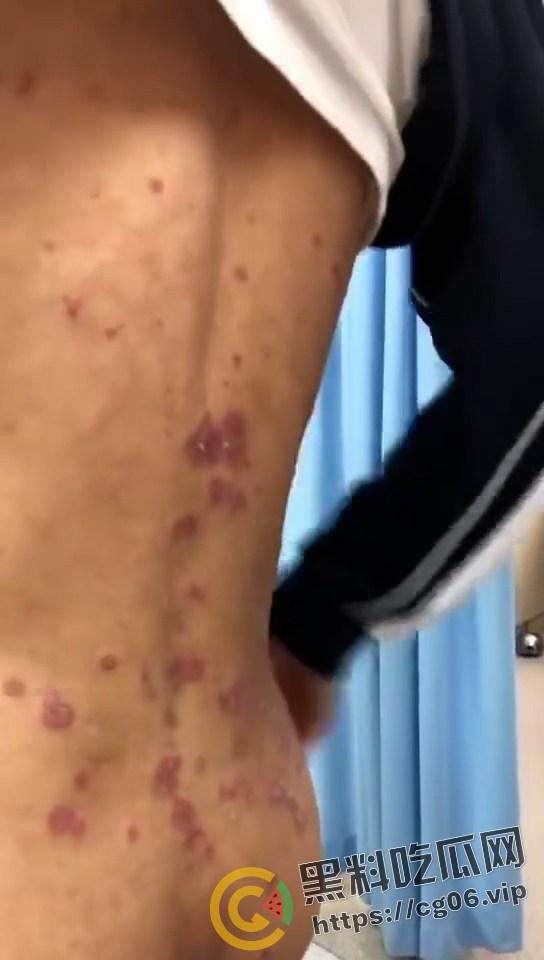 初三学生化身毒王 梅毒三期 艾滋 浑身腐烂 牛子流脓 还说自己没有过性生活 检查现场视频曝光  第4张