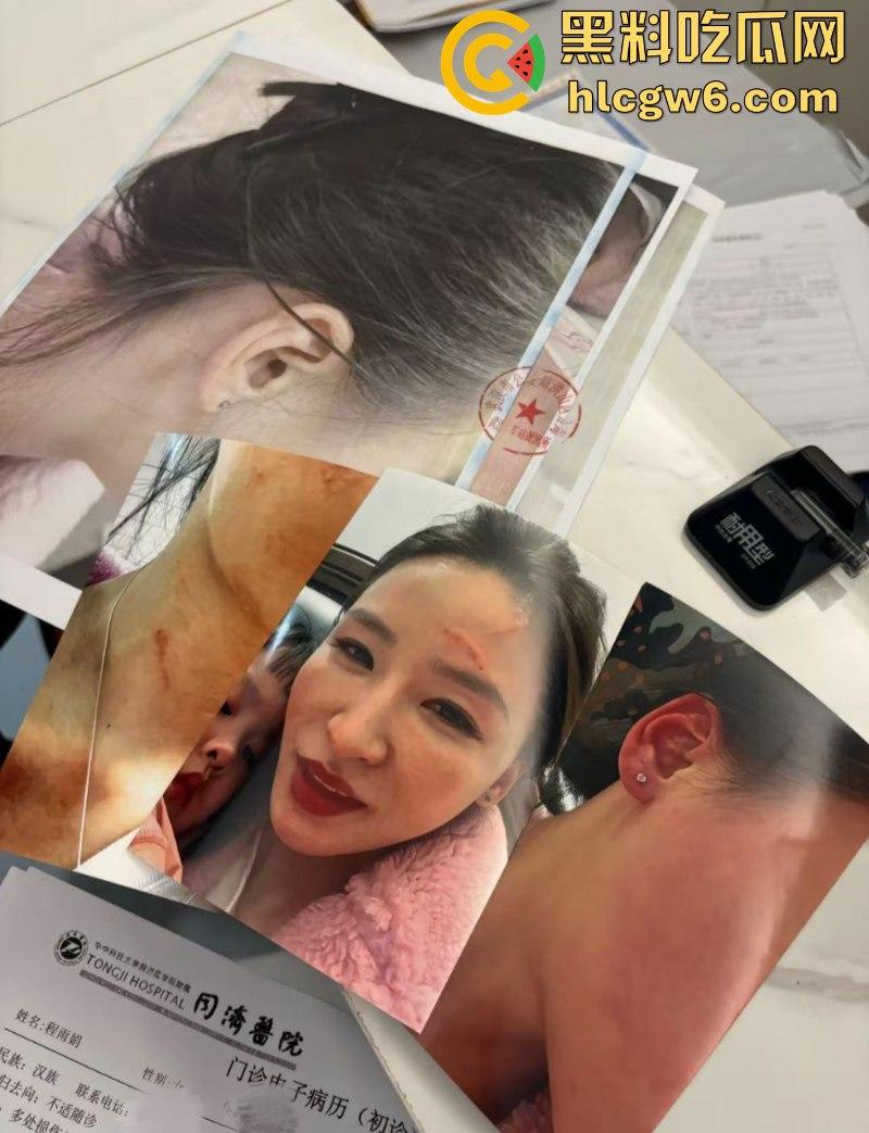 湖北一小学美女老师抖音自曝离婚探女遭前夫爹殴打抓脸全身多处受伤 伤情实拍曝光!都是血口子 第1张 湖北一小学美女老师抖音自曝离婚探女遭前夫爹殴打抓脸全身多处受伤 伤情实拍曝光!都是血口子 第1张