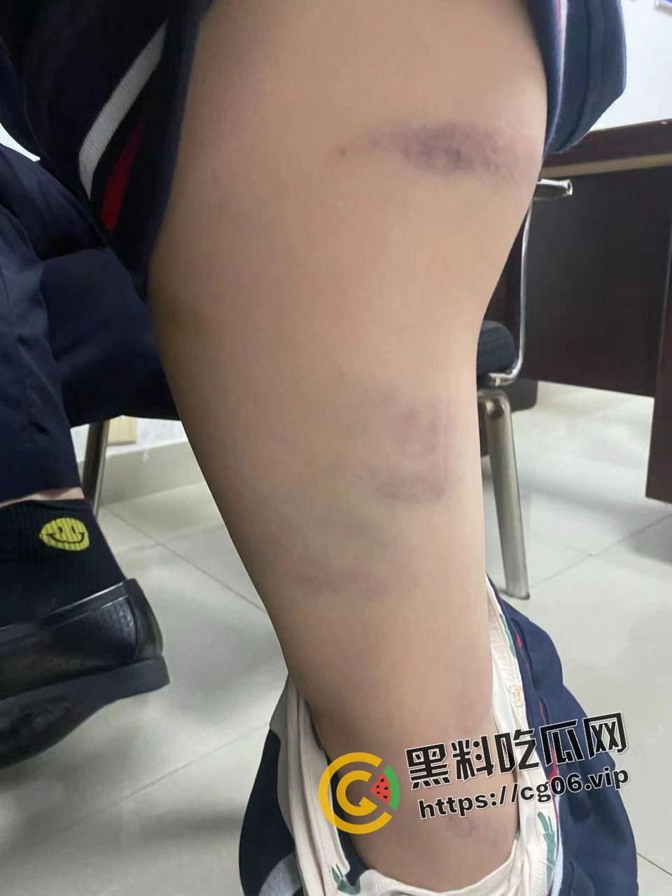 泰州外国语小学老师暴打小学生 全身淤青 家长群内声讨被解散 至今无说法 第16张 泰州外国语小学老师暴打小学生 全身淤青 家长群内声讨被解散 至今无说法 第16张