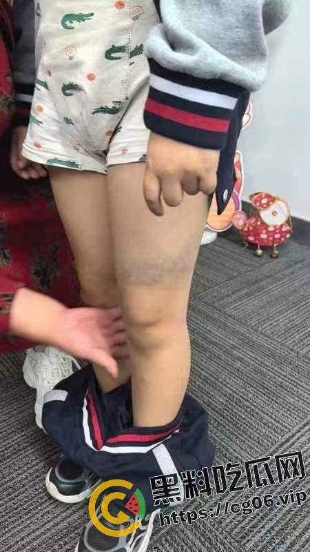 泰州外国语小学老师暴打小学生 全身淤青 家长群内声讨被解散 至今无说法 第17张 泰州外国语小学老师暴打小学生 全身淤青 家长群内声讨被解散 至今无说法 第17张