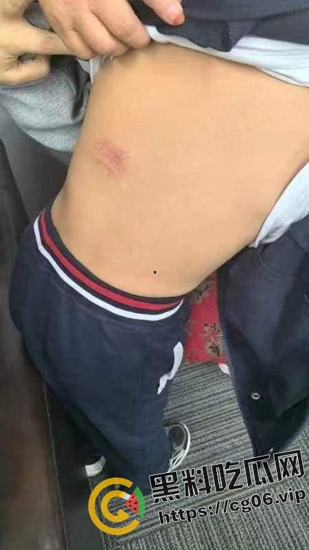 泰州外国语小学老师暴打小学生 全身淤青 家长群内声讨被解散 至今无说法 第18张 泰州外国语小学老师暴打小学生 全身淤青 家长群内声讨被解散 至今无说法 第18张