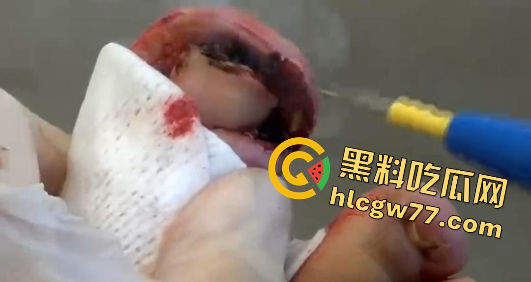 患者天天啃脚指甲狂得甲沟炎！帕尔米耶里手术刀下血肉狂飙，操刀医生差点呕吐！  第3张