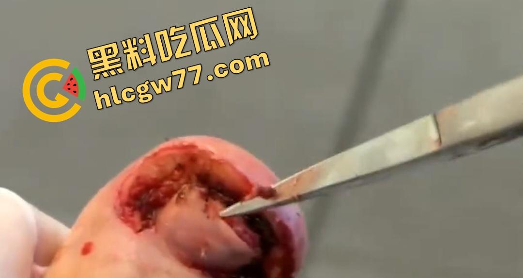 患者天天啃脚指甲狂得甲沟炎！帕尔米耶里手术刀下血肉狂飙，操刀医生差点呕吐！  第4张