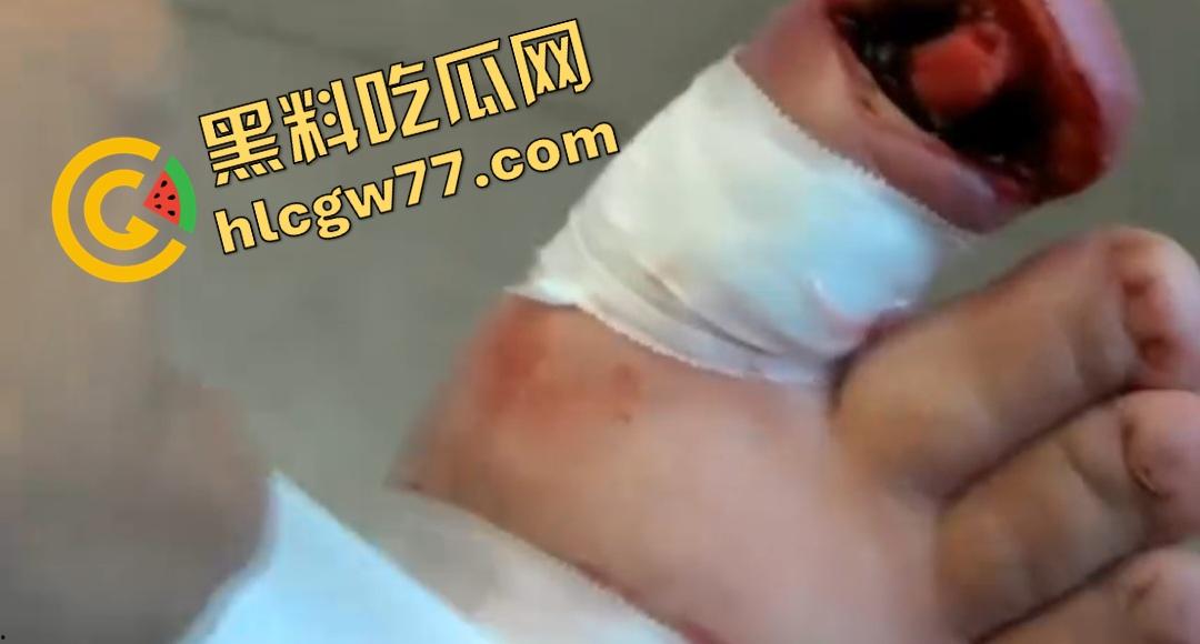 患者天天啃脚指甲狂得甲沟炎！帕尔米耶里手术刀下血肉狂飙，操刀医生差点呕吐！  第5张