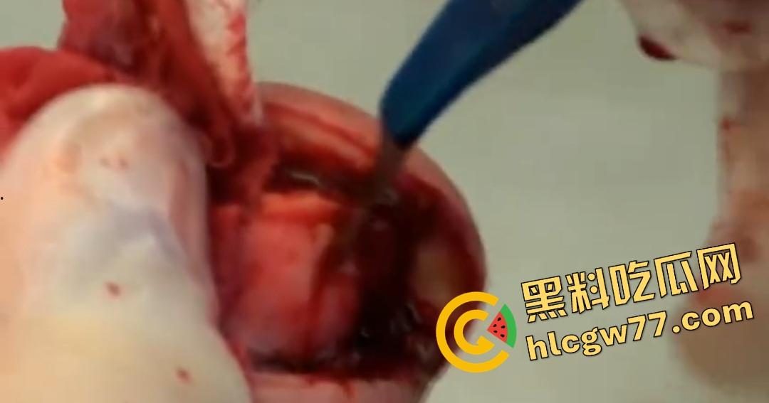 患者天天啃脚指甲狂得甲沟炎！帕尔米耶里手术刀下血肉狂飙，操刀医生差点呕吐！  第6张